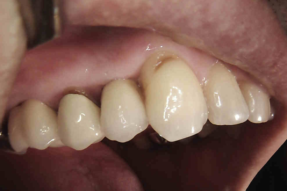results after dental implant crown treatment