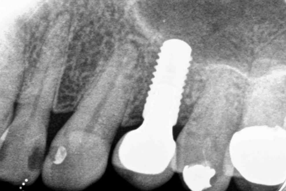 view dental implant in mouth