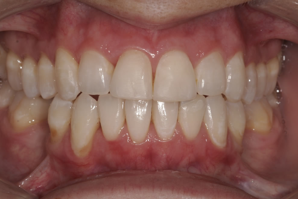 after invisalign treatments