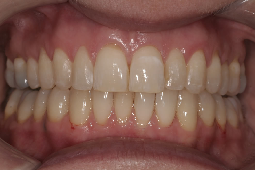 after invisalign treatments