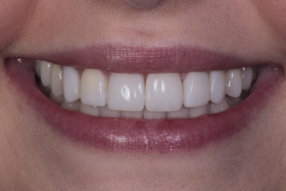 after  composite bonding