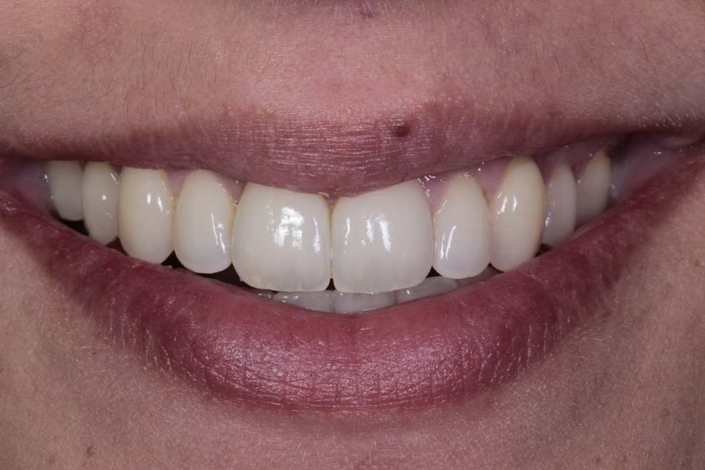 after  composite bonding