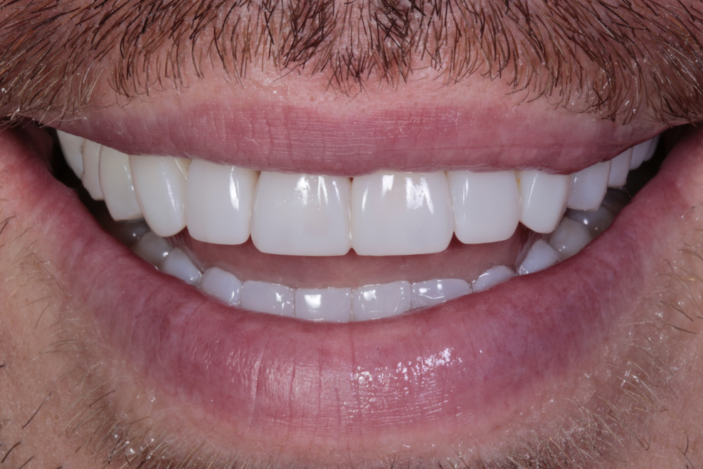 after  composite bonding