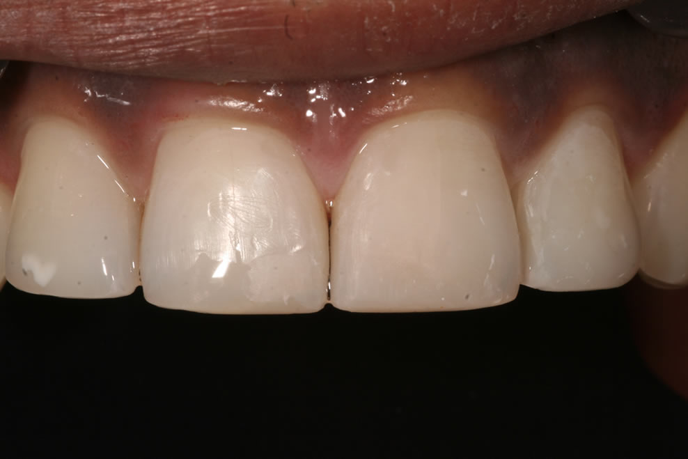 white fillings can fix a broken tooth