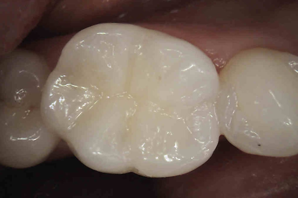 results from white fillings