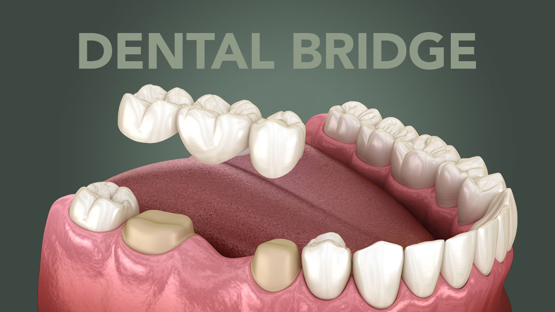 Bridging the Gap: Solutions for Missing Teeth in Hertford & Ware