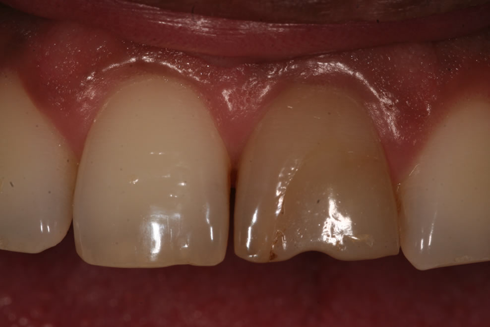 before dental crown treatment