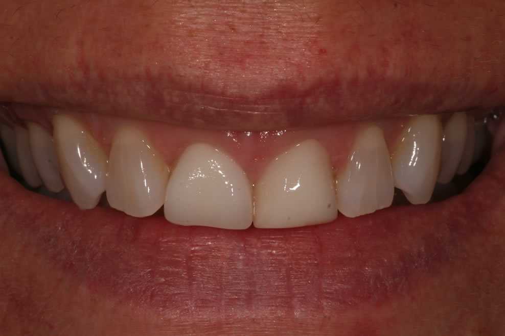gum contouring with veneers