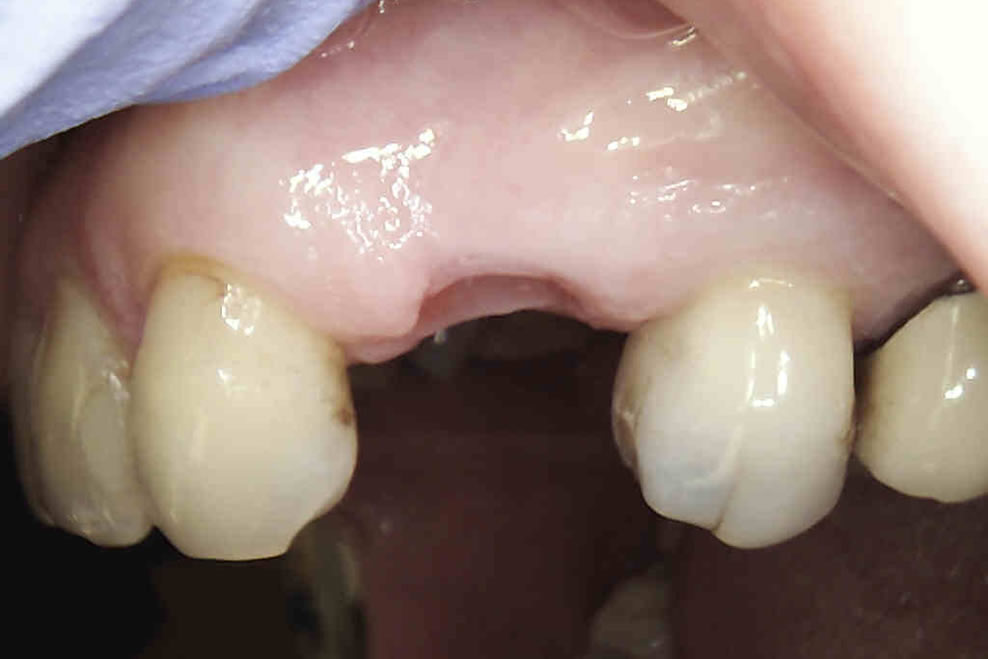 beofre implant treatment
