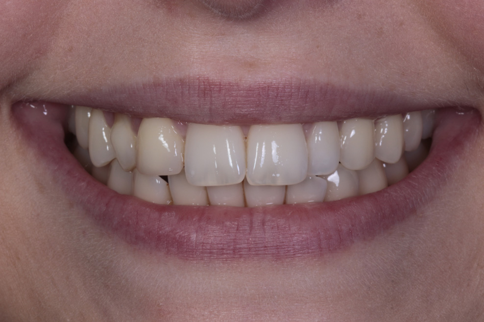 before composite bonding