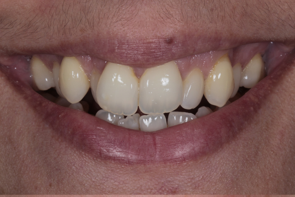before composite bonding