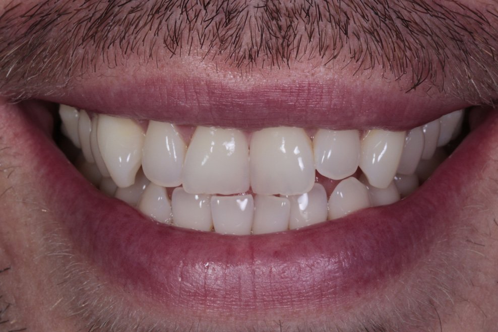 before composite bonding