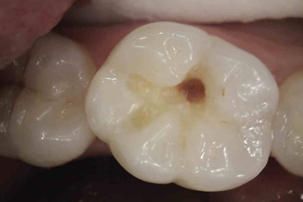 white fillings look much nicer