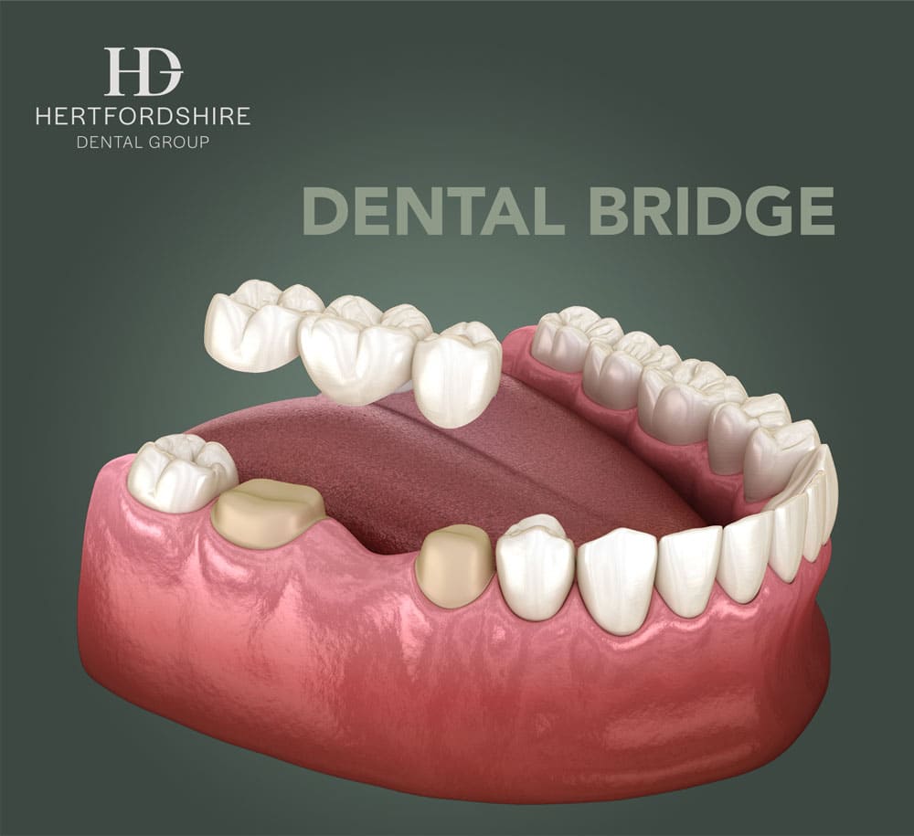 dental bridge