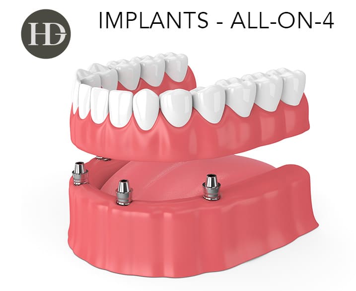 all-on-4 dental implants