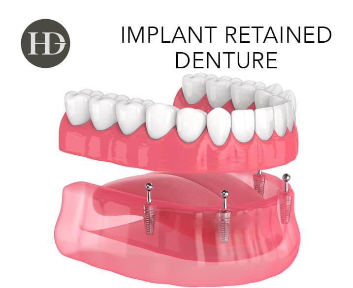 implant retained dentures