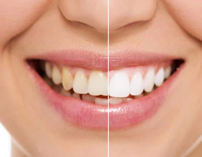 tooth whitening in ware